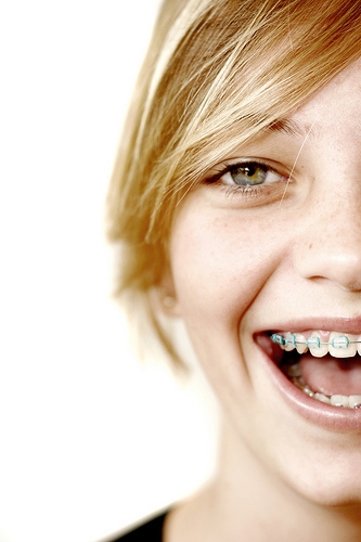 Benefits of Braces