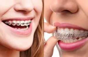 Braces vs. Invisalign